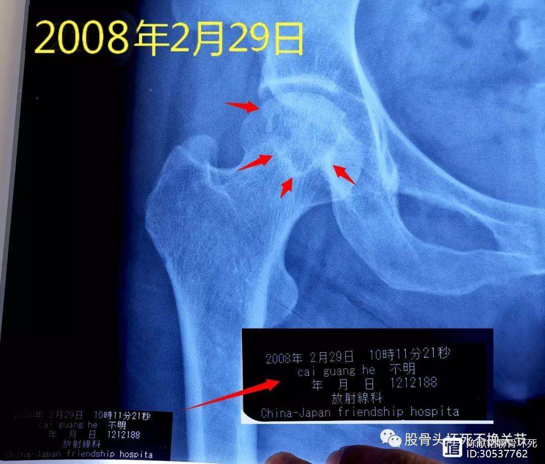 淮安人工骨头医保报销多少(人工骨头医保报销多少比例)